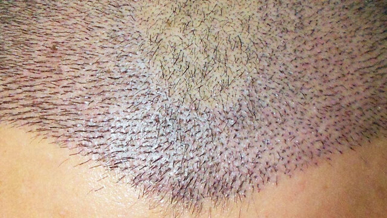 Doktor İsmail Küçüker: Yurt dışından ciddi sayıda insan saç ekimi için Türkiye’yi tercih etmekte