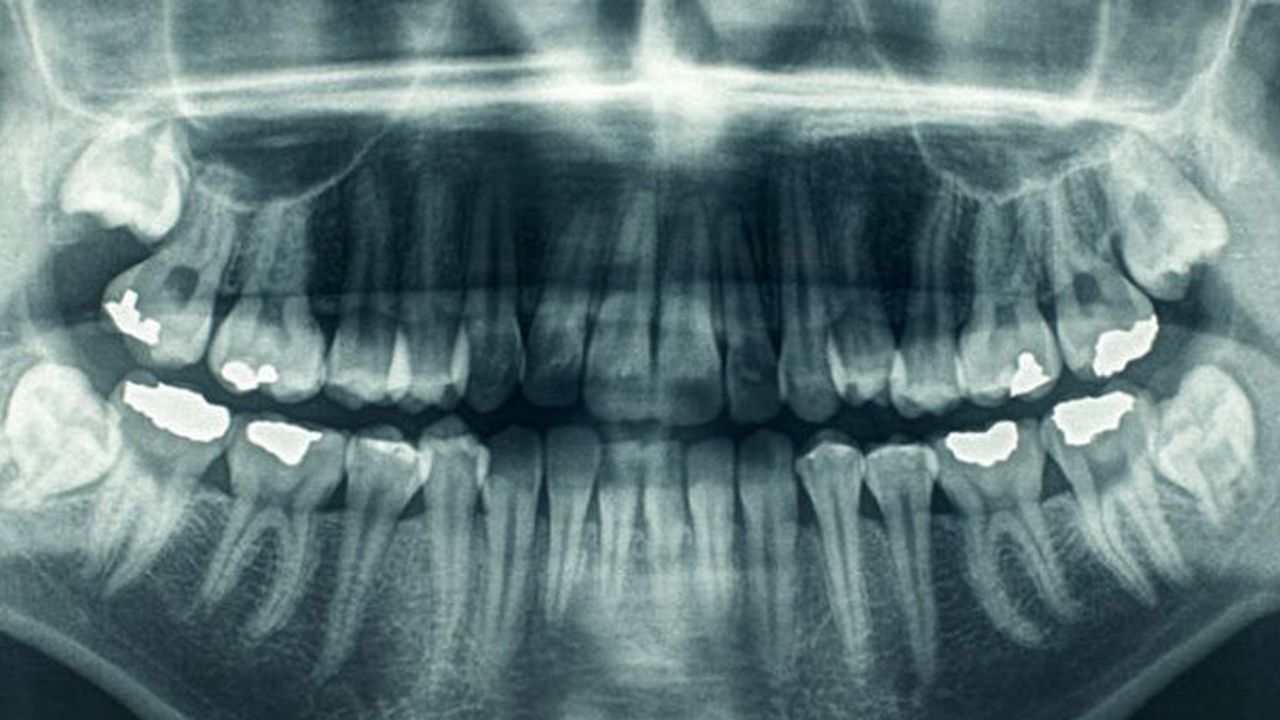 Kök hücre dolguları ile diş çürükleri tarih olabilir mi?