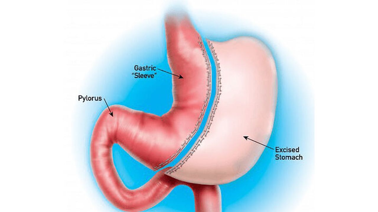 Türkiye'de yılda yaklaşık 9 bin kişi mide küçültme ameliyatı oluyor