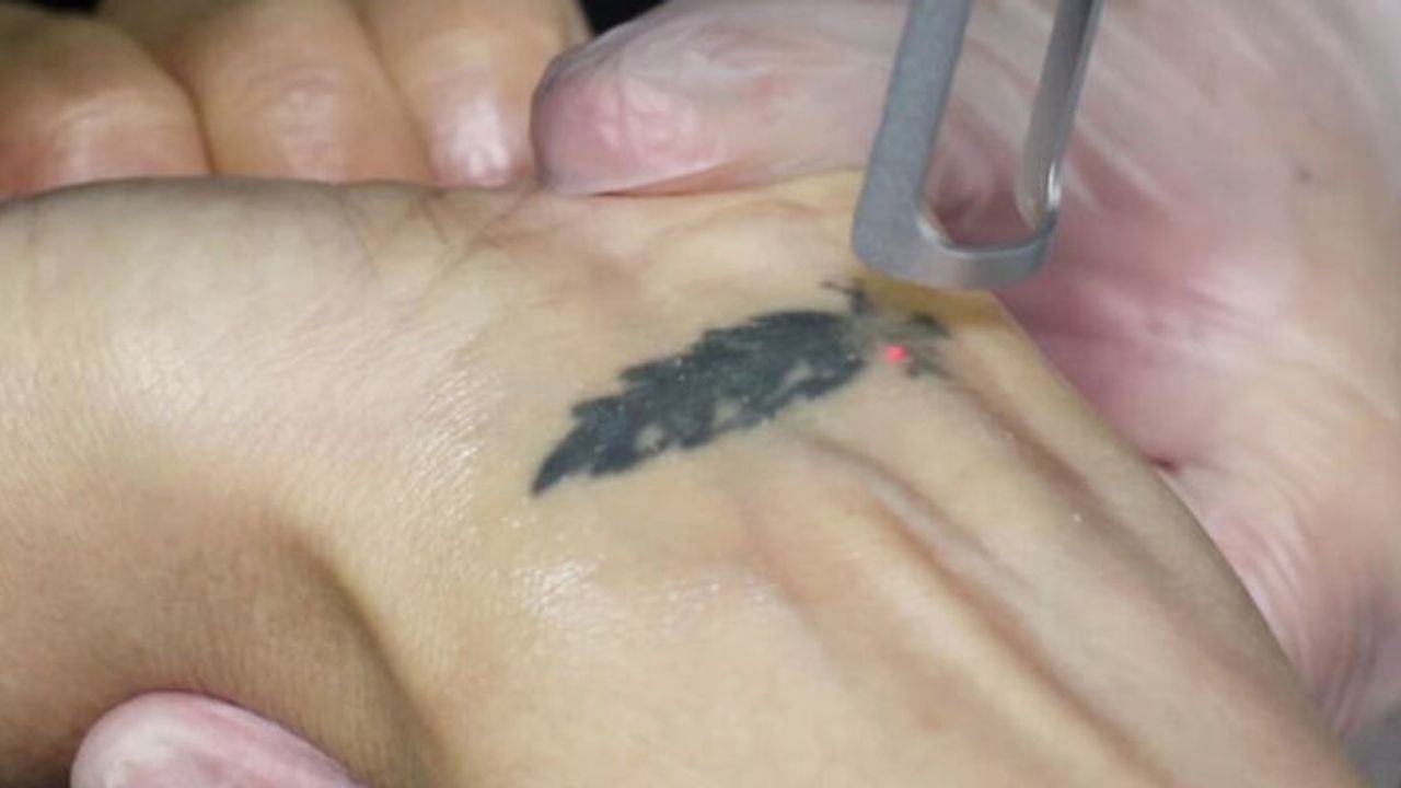 Biten aşklar dövme sildirmenin birinci nedeni