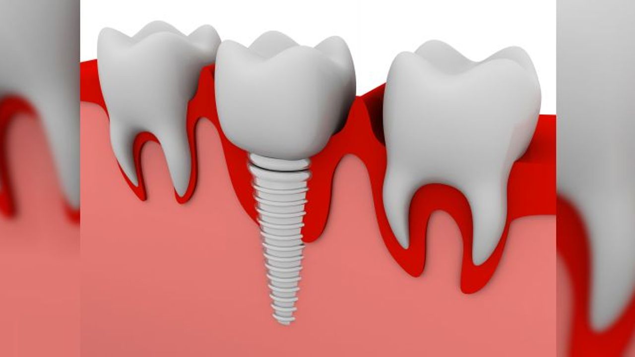 İmplant ile ilgili merak edilen 6 soru