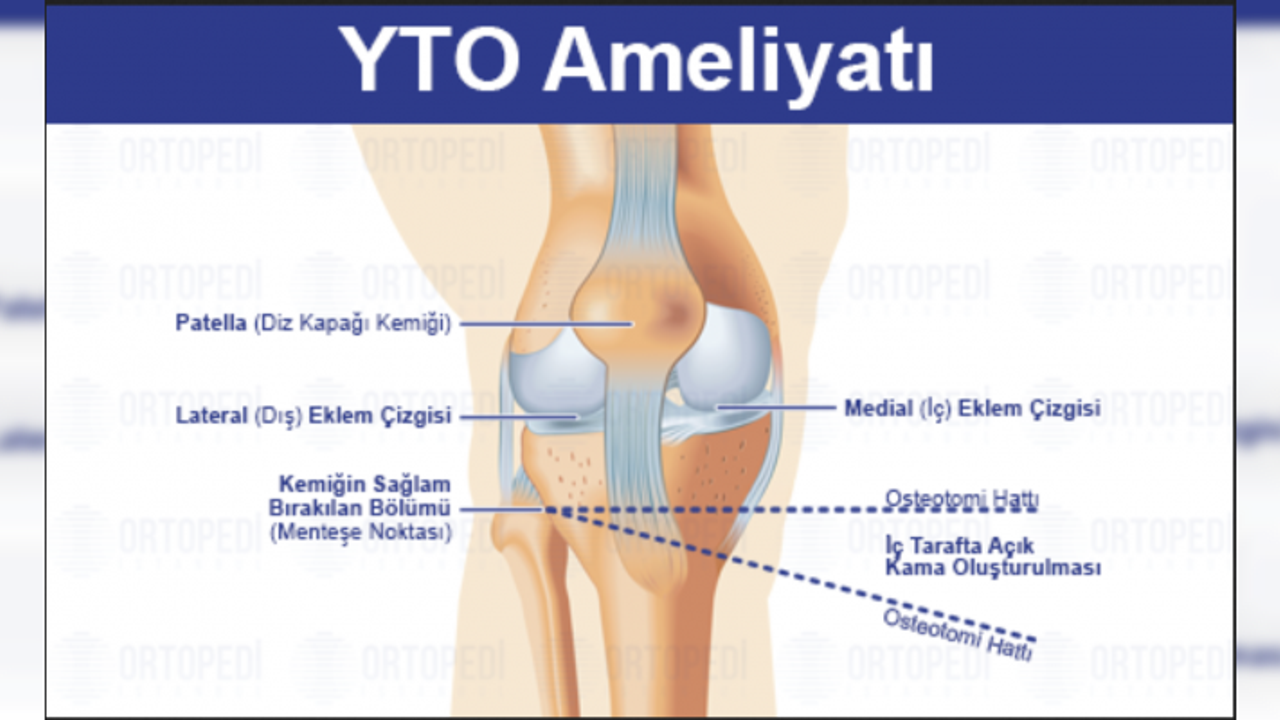 Yüksek Tibial Osteotomi (YTO): Diz Ağrısından Fonksiyona Giden Yol, Aklınızdaki Tüm Sorular ve Bizce En Mantıklı İyileşme Stratejisi