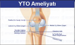 Yüksek Tibial Osteotomi (YTO): Diz Ağrısından Fonksiyona Giden Yol, Aklınızdaki Tüm Sorular ve Bizce En Mantıklı İyileşme Stratejisi