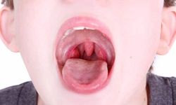 Çocuklarda geniz eti büyümesinin belirtileri ve tehlikeleri