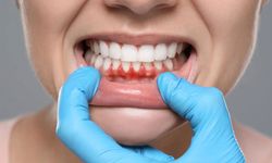 Düşük bağışıklık sistemi veya stres diş etlerini etkileyebilir