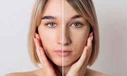 Akne oluşumuna yol açan 7 hatalı alışkanlık