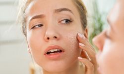 Kışın cilt kuruluğuna karşı 6 etkili önlem