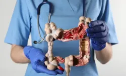 Kolon kanserleri genellikle belirti vermeden ilerliyor!