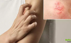 50 Yaş Üstü İçin Uyarı Zona Hastalığı Nasıl Ortaya Çıkar