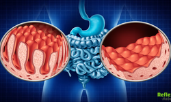 Bağırsak Düğümlenmesi Neden Olur? İşte Kritik Sebepler