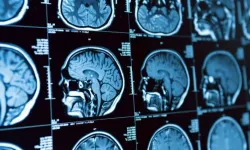 Beyin Kanaması Belirtileri Ani Baş Ağrısına Dikkat