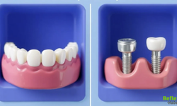 Diş Estetiğinde İmplant Mı ? Kaplama Mı Öne Çıkıyor ?