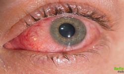 Göz Yanması Neden Olur? İşte En Yaygın Sebepler