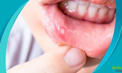 Sık Çıkan Aftlara Dikkat Vücudunuzun Verdiği Sinyaller