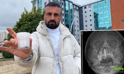 5 Yaşındaki Polen’in Burnundan 2 Yıllık Zincir Çıktı İhmal İddiası Gündemde