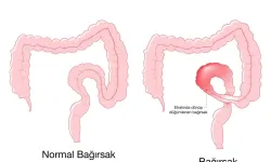Bağırsak Düğümlenmesi Nasıl Anlaşılır? Dikkat Edilmesi Gereken İşaretler