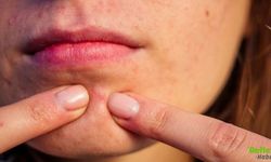 Çenede Sivilce Oluşumunun Nedeni Nedir
