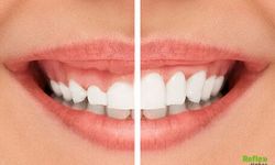 Diş Eti Çekilmesi Neden Olur? Ne İyi Gelir?