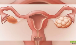 Polikistik Over Sendromu Nasıl Anlaşılır? İşte En Yaygın Belirtiler