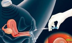 Tüp Bebekte En Kritik Aşama Embriyolar Rahme Nasıl Yerleştirilir