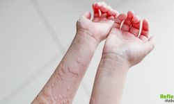 Ürtiker Neden Olur: Kurdeşenin Sebepleri Neler