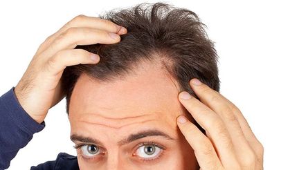 Erkeklerde genetik saç dökülmesi nasıl önlenir?