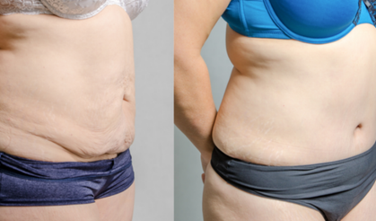 Karın Germe Hangi Amaçla Yapılır?