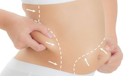Liposuction Nedir? Yöntemleri Nelerdir?