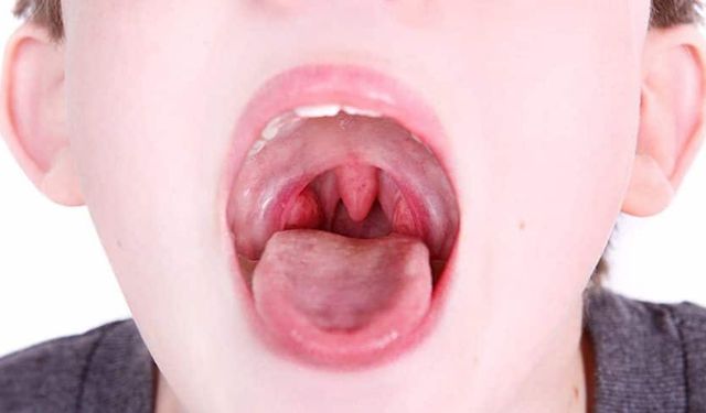 Çocuklarda geniz eti büyümesinin belirtileri ve tehlikeleri