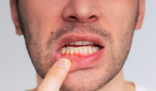 Diş eti çekilmesinin en büyük sebebi diş taşı!