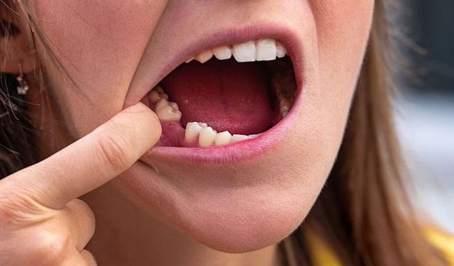 Diş kaybı yalnızca estetik bir sorun değil!