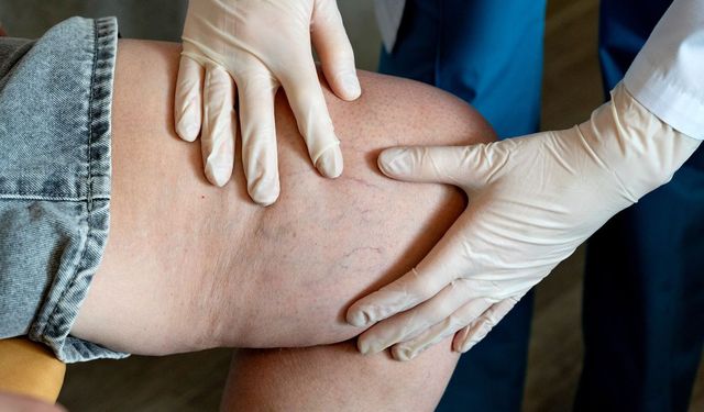 Lipödemsiz bir yaşam için 7 öneri