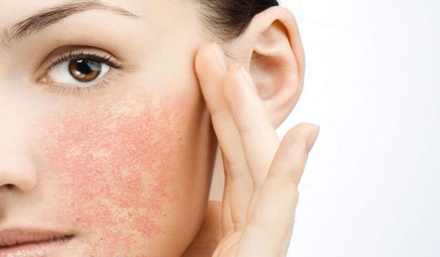 Mevsim geçişlerinde cilt bariyeri alarm veriyor