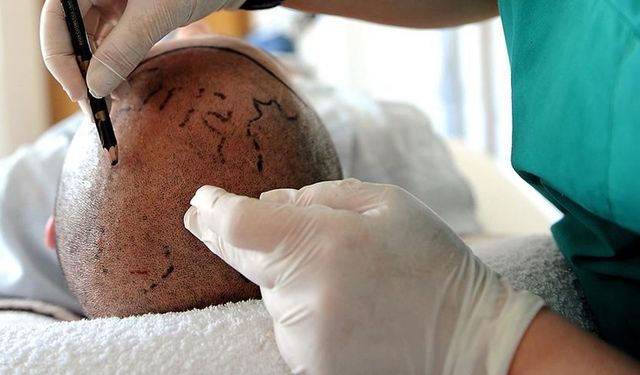 Tabip Odası duyurdu: Hekim olmadığı halde saç ekimi yapan kişiye hapis cezası verildi