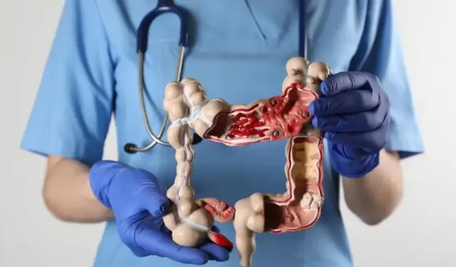 Kolon kanserleri genellikle belirti vermeden ilerliyor!