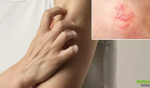 50 Yaş Üstü İçin Uyarı Zona Hastalığı Nasıl Ortaya Çıkar