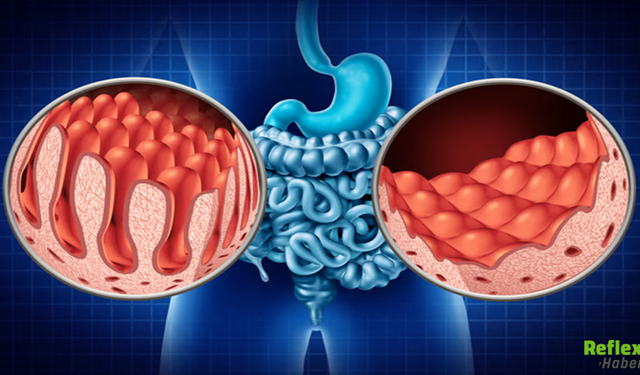 Bağırsak Düğümlenmesi Neden Olur? İşte Kritik Sebepler