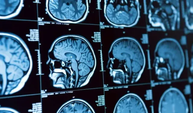 Beyin Kanaması Belirtileri Ani Baş Ağrısına Dikkat