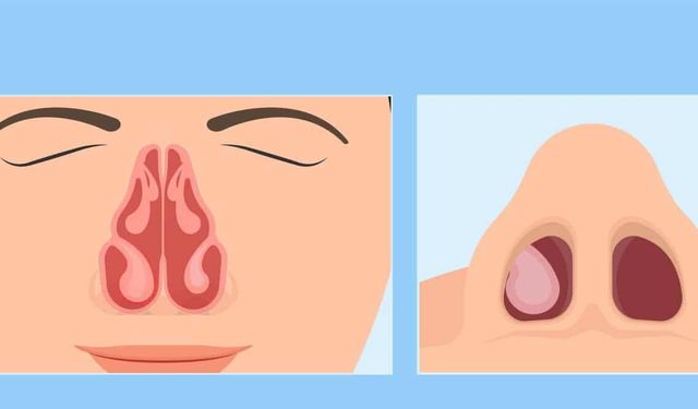 Burun Eti Büyümesi Neden Olur İşte En Yaygın Sebepler