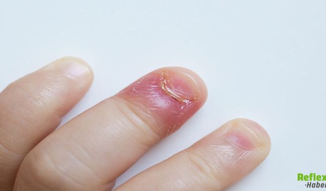 Dolama Neden Olur? Parmaktaki İltihabın Sebebi Ne?