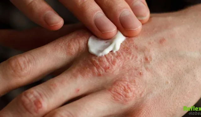 Egzama Neden Çıkar Ve Nasıl Kontrol Altına Alınır