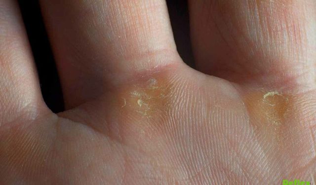 Ellerde Nasır Neden Oluşur İşte En Yaygın Sebepler