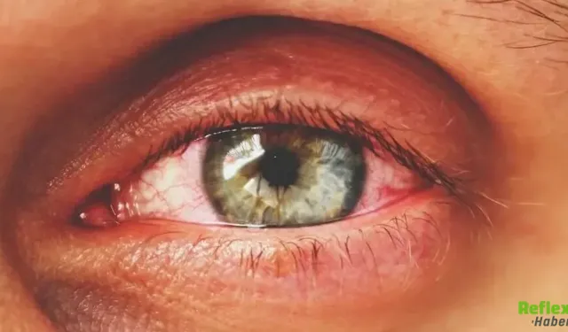 Görme Kaybına Yol Açabilen Göz Tansiyonu Hakkında Bilmeniz Gerekenler