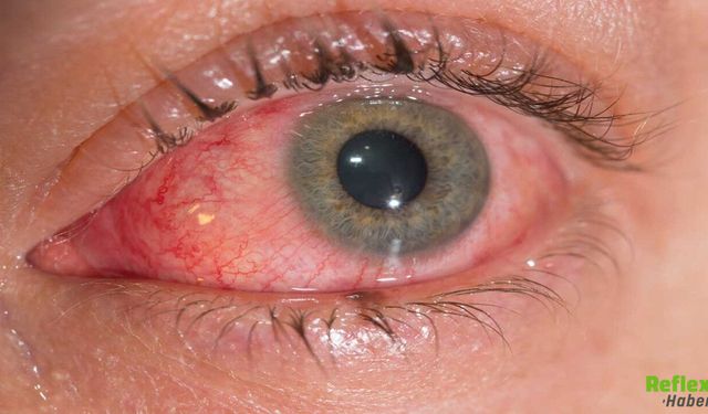 Göz Yanması Neden Olur? İşte En Yaygın Sebepler