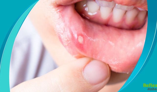 Sık Çıkan Aftlara Dikkat Vücudunuzun Verdiği Sinyaller