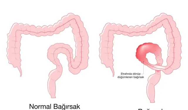 Bağırsak Düğümlenmesi Nasıl Anlaşılır? Dikkat Edilmesi Gereken İşaretler