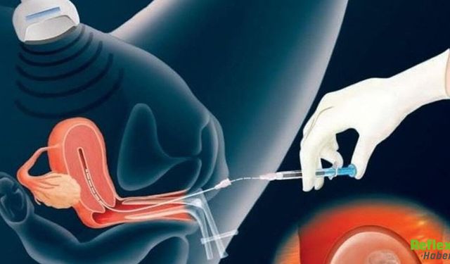 Tüp Bebekte En Kritik Aşama Embriyolar Rahme Nasıl Yerleştirilir
