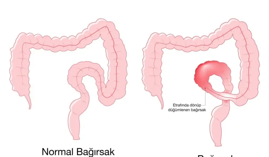 Bağırsak Düğümlenmesi Nasıl Anlaşılır? Dikkat Edilmesi Gereken İşaretler
