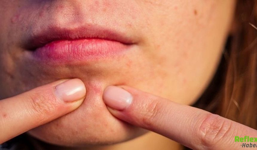 Çenede Sivilce Oluşumunun Nedeni Nedir