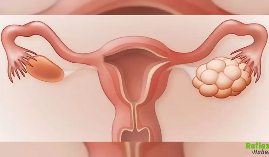 Polikistik Over Sendromu Nasıl Anlaşılır? İşte En Yaygın Belirtiler